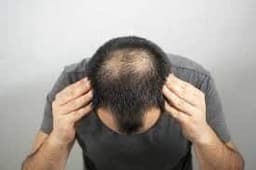 rụng tóc di truyền có chữa được không