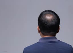 Hói đỉnh đầu có thể ảnh hưởng đến sự tư tin và tâm lý của người gặp phải (Nguồn: Internet)