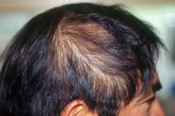 Mất tự tin vì hói đầu, tóc thưa?