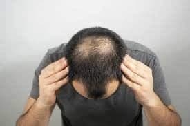 rụng tóc di truyền có chữa được không